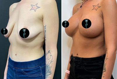 breast augmentation before after