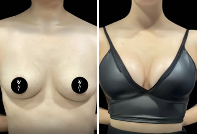 breast augmentation before after