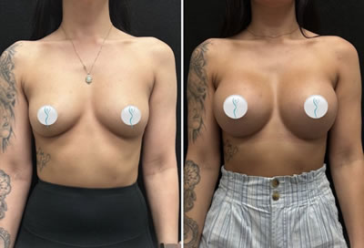 breast augmentation before after