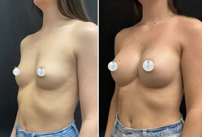 breast augmentation before after