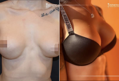 breast augmentation before after