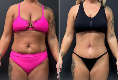 liposuction before after