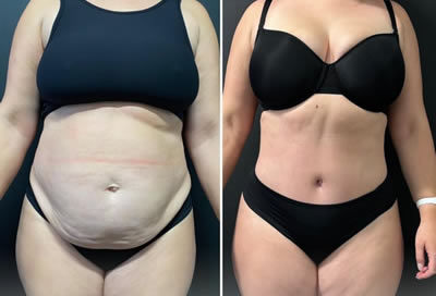 liposuction before after