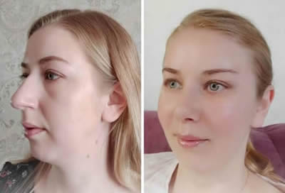 middle face lift before after