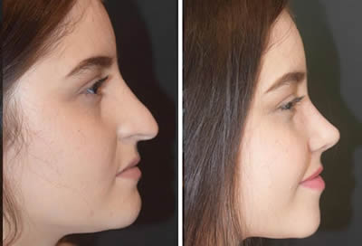 rhinoplasty before after