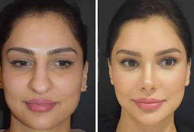 nose job before after