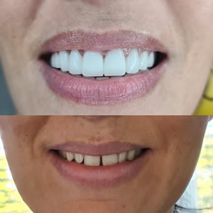 cosmetic dentistry before after