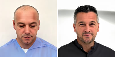hair transplamt before after