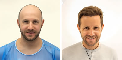 hair transplamt before after
