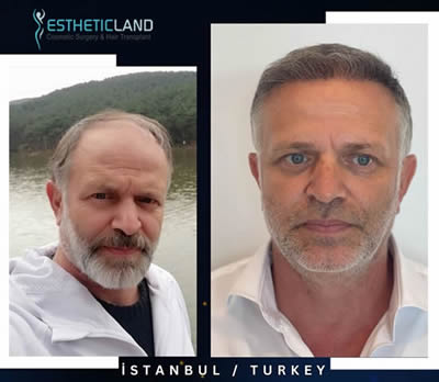 hair transplamt before after