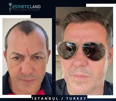 hair transplamt before after