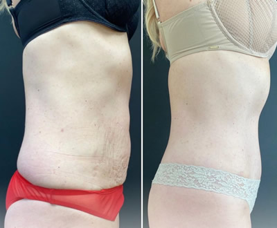 Liposuction before after 3