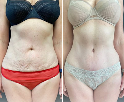 Liposuction before after 4
