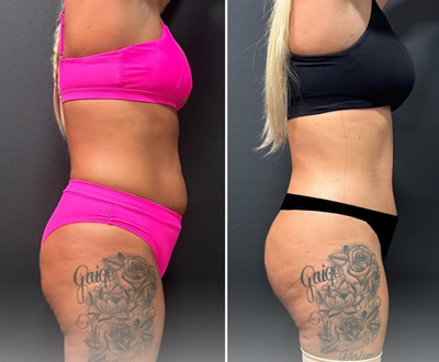 Liposuction before after 5