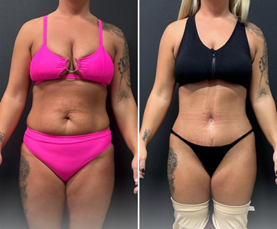 Liposuction before after 6