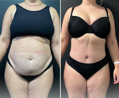Liposuction before after 1
