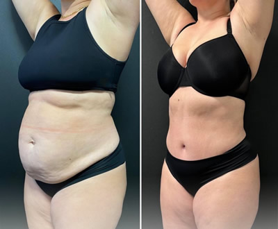 Liposuction before after 2