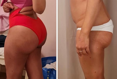 boob augmentation before after