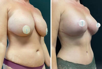 breast augmentation before after
