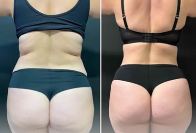 Liposuction before after