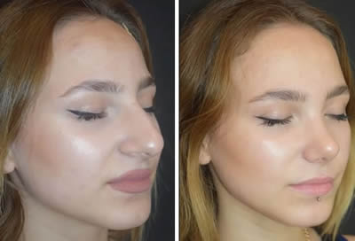 nose job surgery before after