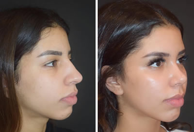 nosejob before after